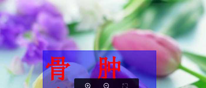 骨骼常见病Ｘ线表现与诊断3(肿瘤).ppt