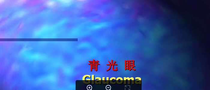 青光眼.ppt